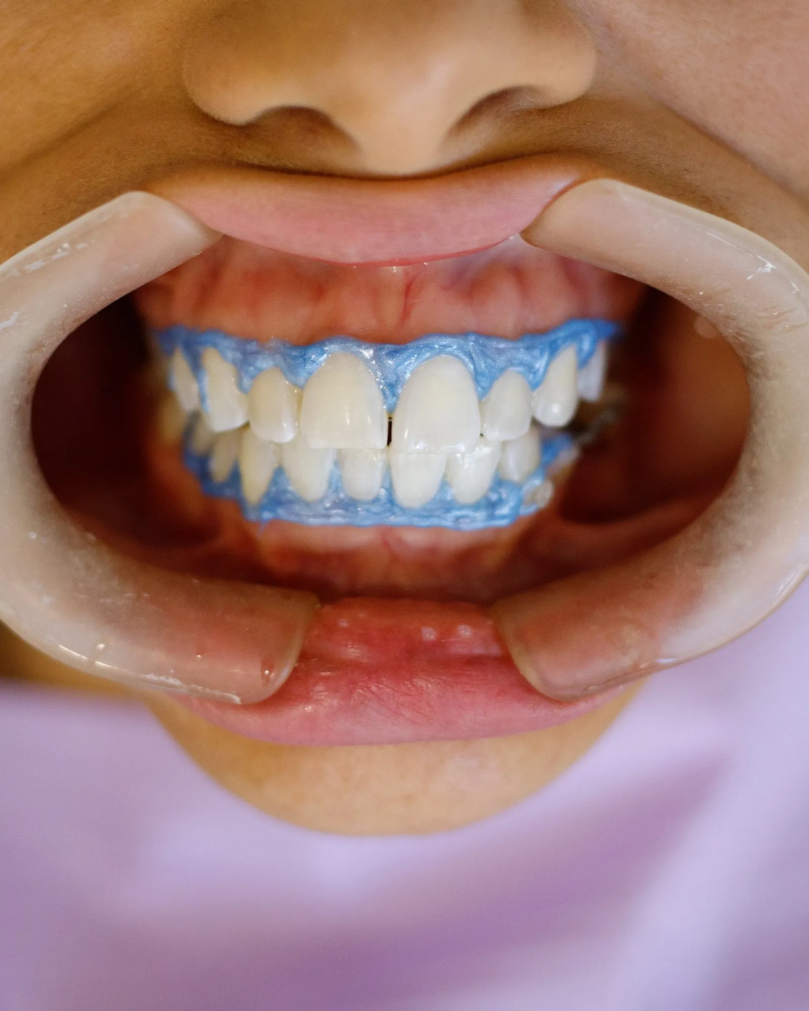 Sorriso de paciente do Consultório Cousin